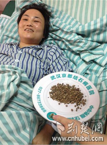 湖北一女子二十年不过早 患胆囊结石百余颗