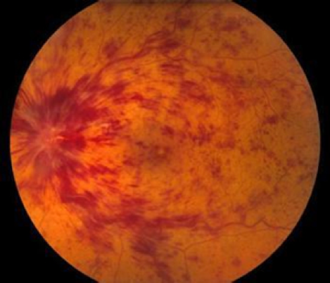 视网膜中央静脉阻塞怎么治疗？