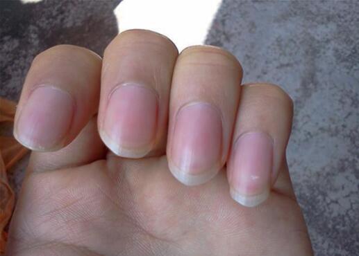 灰指甲的前期征兆与治疗方法