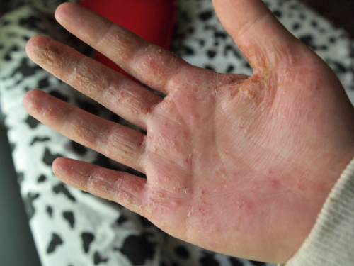手指真菌感染症状