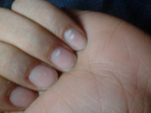 指甲为什么出现白点 有白点是病吗?