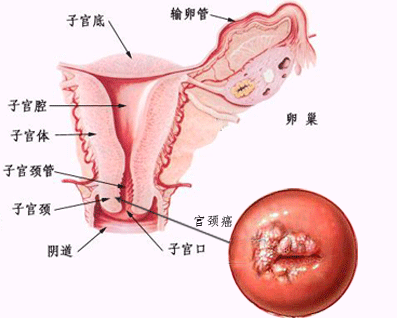 宫颈癌的基本常识及科学治疗与预防