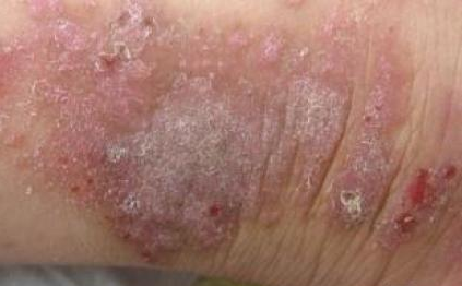 神经性皮炎怎么治?针对疗法快速治愈