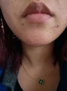 怎样去痘痘和痘印 闭口痘痘怎么处理