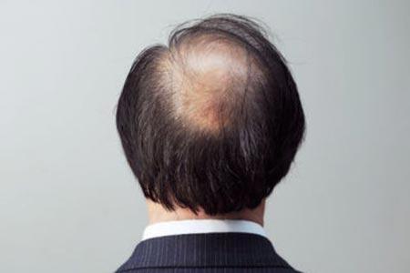 爸爸4沙溢严重秃顶 男性脱发的饮食治疗_健康_腾讯网