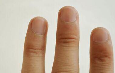 灰指甲的治疗方法 灰指甲如何根治?