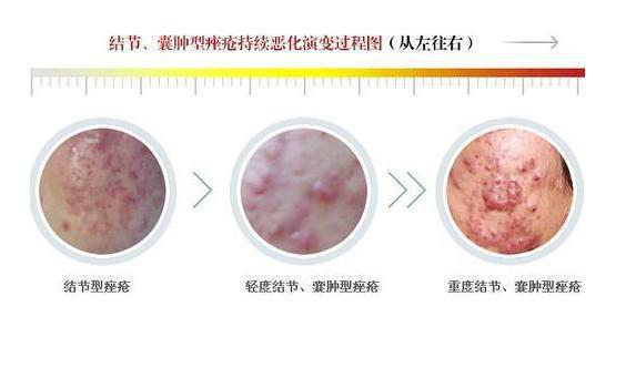 祛除各类痘痘的小窍门!你都知道吗?