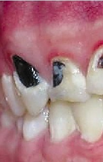 杭州16岁男孩牙齿被可乐酸蚀后一片片脱落