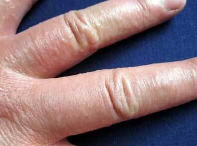 专家支招:如何治疗手足部湿疹?
