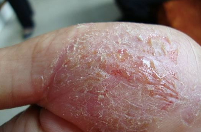 干裂型湿疹怎么治?采用中医特制小偏方