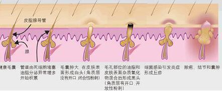 了解青春痘发病机理 教你快速祛痘成功小窍门283 / 作者:疾控客服 / 帖子ID:162398