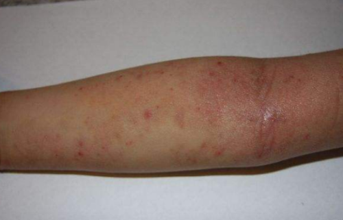 慢性湿疹的中成药 科学治疗根除湿疹!