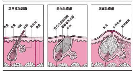 了解青春痘发病机理 教你快速祛痘成功小窍门667 / 作者:疾控客服 / 帖子ID:162398 了解青春痘发病机理 教你快速祛痘成功小窍门667 / 作者:疾控客服 / 帖子ID:162398