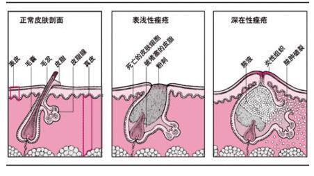 了解青春痘发病机理 教你快速祛痘成功小窍门92 / 作者:疾控客服 / 帖子ID:162398