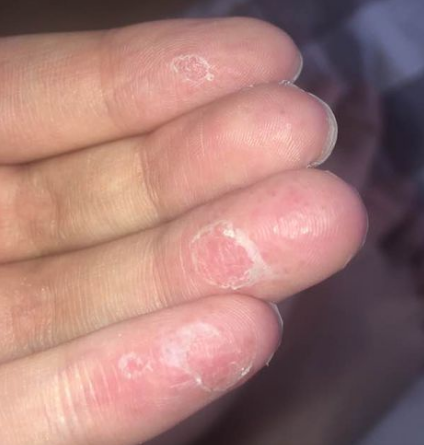 鹅掌风怎样才能治好?手癣少不了日常护理