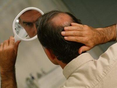 男性型脱发的原因与植发治疗的注意事项