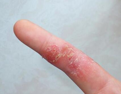 手掌手指湿疹可以根治吗?