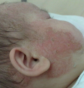 婴儿外耳道湿疹 宝妈推荐最佳治疗方法