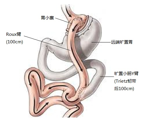 白话医学02期:什么是胃旁路手术