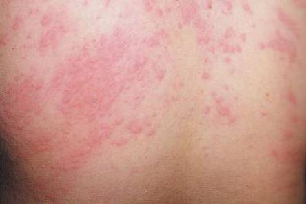 从而出现局部的湿疹样皮炎,称之为皮肤真菌感染的湿 疹化,简称真菌性