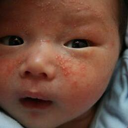 婴儿湿疹怎么办?小儿过敏性湿疹的症状及日常