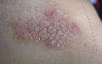 为什么会有神经性皮炎 治愈偏方药到病除