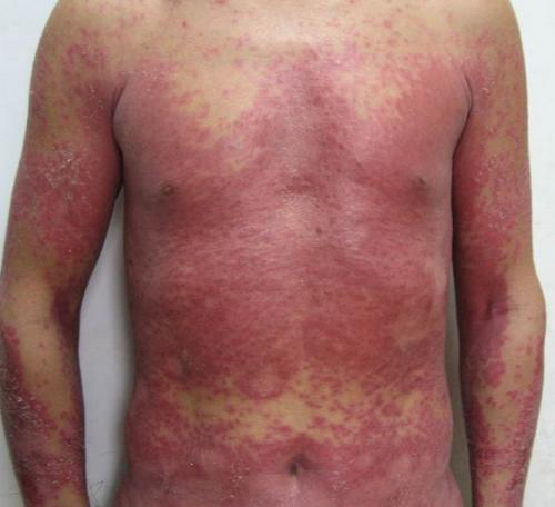 老中医教你怎么治疗真菌感染引起的湿疹 - 百姓