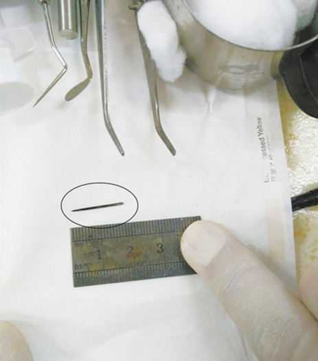 “熊孩子”玩耍时误将缝衣针扎入门牙根管