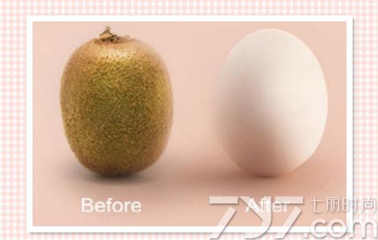 光子脱毛原理是什么?五秒让你看懂_大燕网河北站_腾讯网