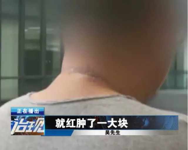 男子一巴掌拍死一只虫 导致半个脖子烂掉