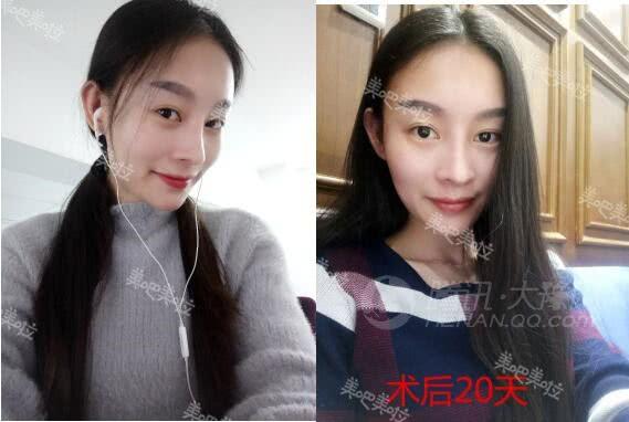 【美吧美啦案例】23岁女孩儿肋软骨隆鼻后,神