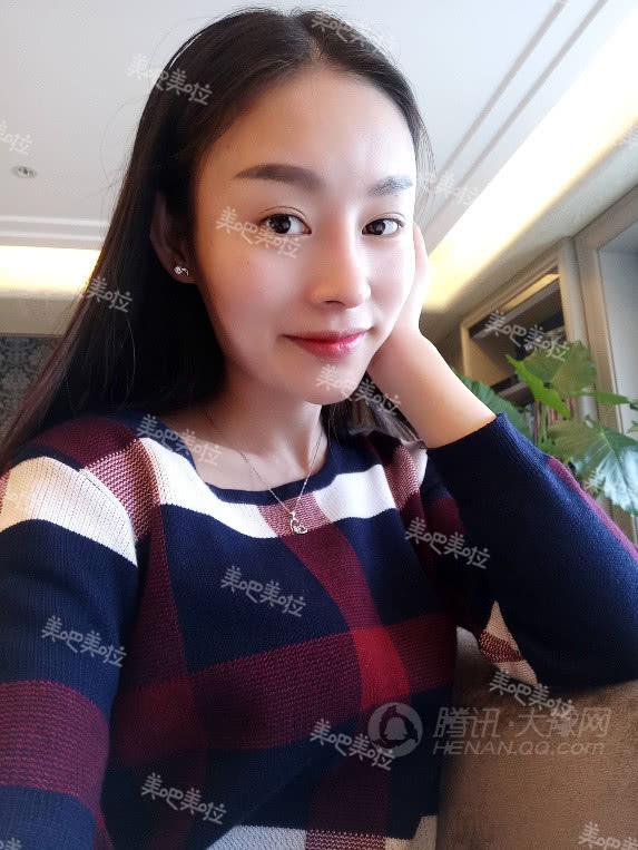 【美吧美啦案例】23岁女孩儿肋软骨隆鼻后,神
