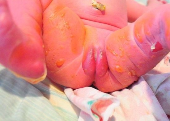 婴儿出生两天妇幼院洗澡 全身被烫伤43%(图)