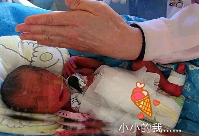 濮阳孕妇生出“巴掌女婴” 仅在母体孕育6个月