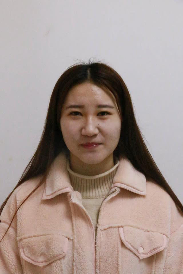 美吧美啦案例:90后女生隆鼻 效果惊艳众人