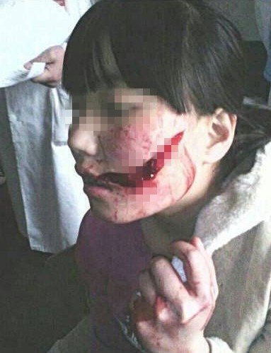 伊川实验中学一女生被同学划脸 鲜血瞬间喷出