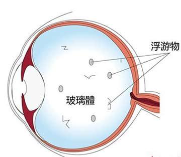 眼睛前面有东西在飘_眼睛看前面有个小黑影_眼睛感觉有东西遮挡