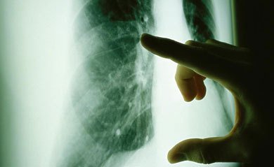 这6类人要拍胸片预防肺癌 重度吸烟者