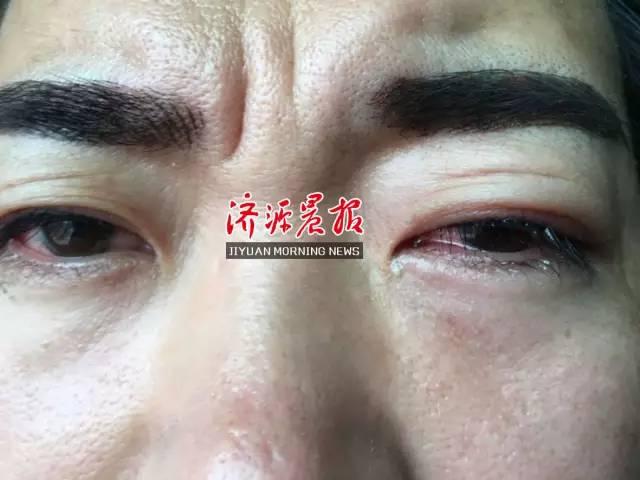 济源男子花千元纹美瞳线 不料眼角膜受损住医