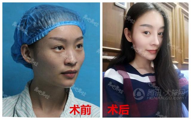 【美吧美啦案例】23岁女孩儿肋软骨隆鼻后,神