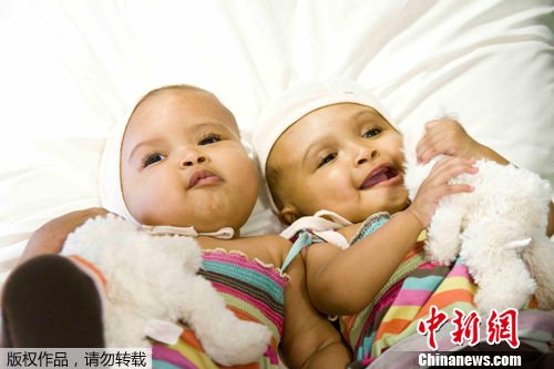 苏丹头颅连体双胞胎女婴成功手术分离