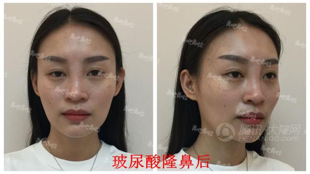 【美吧美啦案例】23岁女孩儿肋软骨隆鼻后,神
