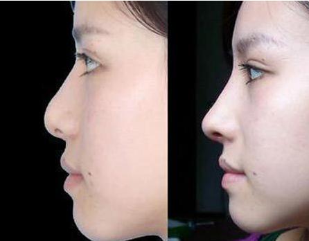 一些常见整形项目的维持时间_大豫网_腾讯网