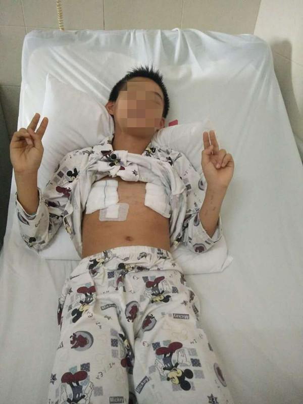 长沙11岁男孩胸口有个坑 错误补钙漏斗胸凹