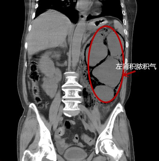 结石藏身10年 平日不痛不痒如今却面临割肾