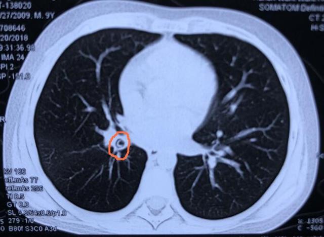 湖南9岁男童频繁咳嗽喘 医生从肺里取出一根