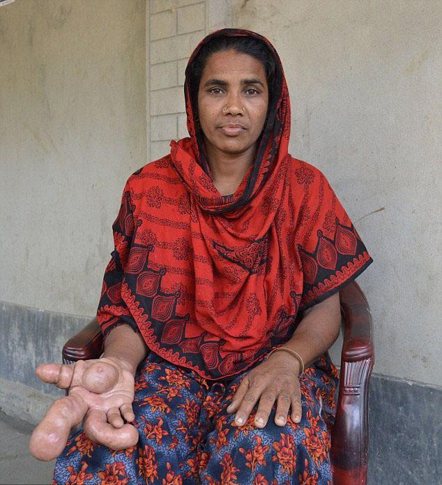 孟加拉一女子患罕见病 右手肿成足球大小