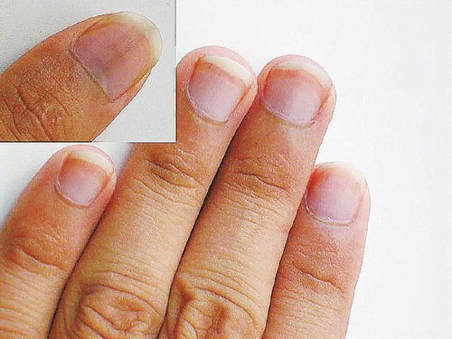 指甲凹陷可能贫血+多数人的指甲平滑且有一定