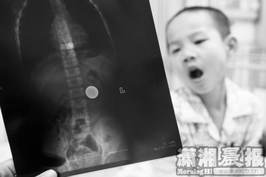 湖南5岁男孩幼儿园吞硬币 或尝试通过肠道排出