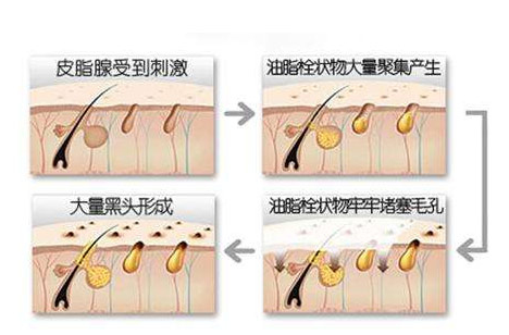 由此得出结论:出油主要原因是皮脂腺分泌过于旺盛!